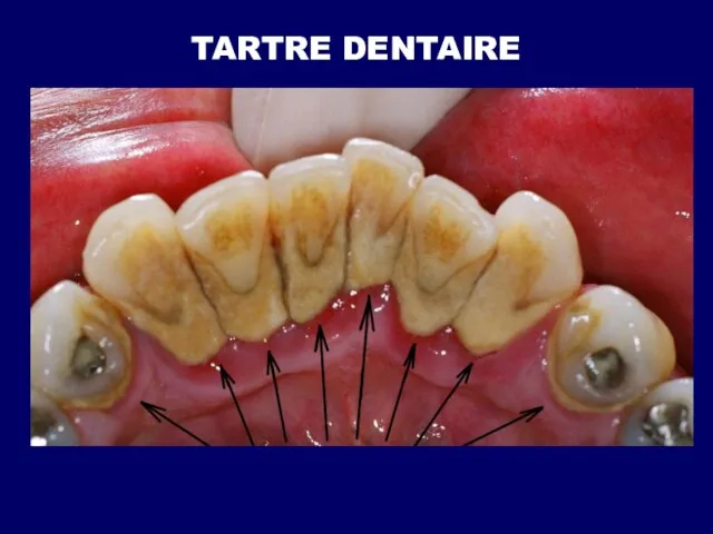 TARTRE DENTAIRE