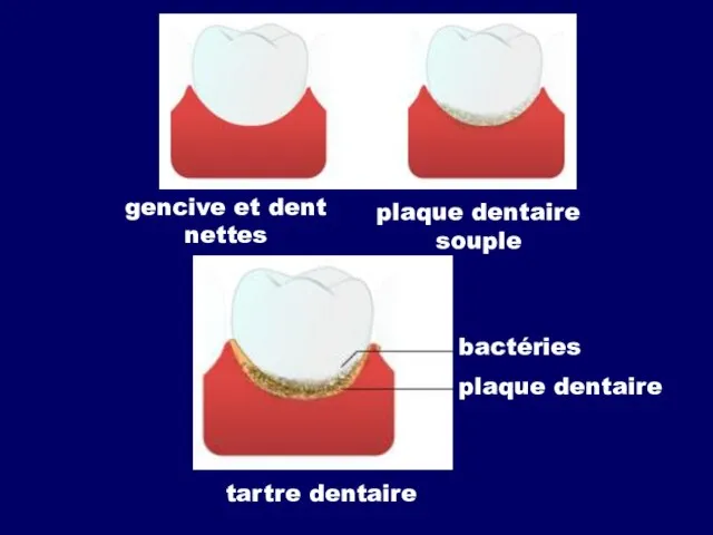 gencive et dent nettes plaque dentaire souple tartre dentaire bactéries plaque dentaire