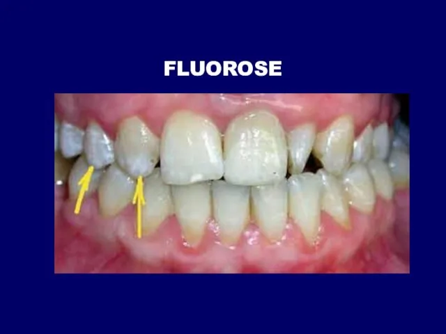 FLUOROSE