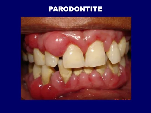 PARODONTITE