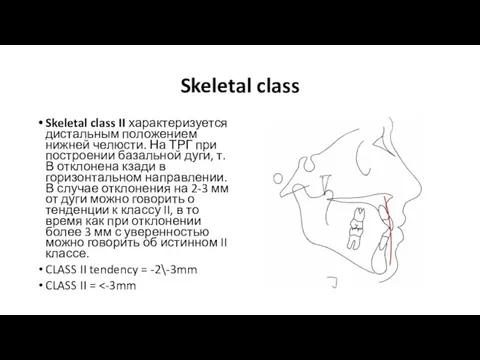 Skeletal class Skeletal class II характеризуется дистальным положением нижней челюсти. На ТРГ