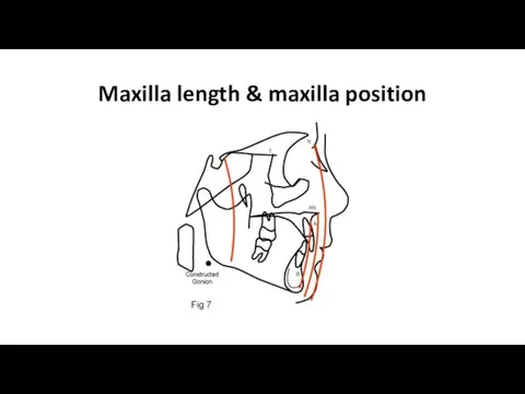 Maxilla length & maxilla position