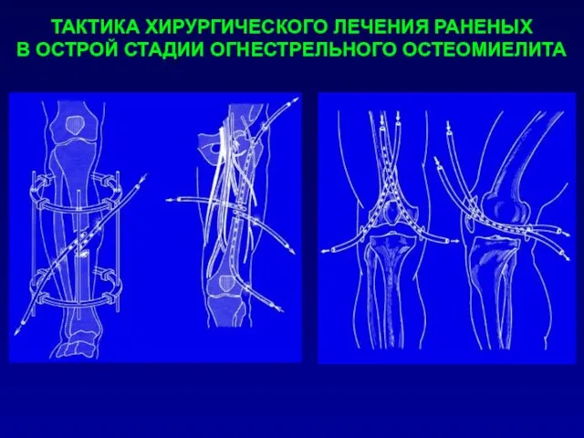 ТАКТИКА ХИРУРГИЧЕСКОГО ЛЕЧЕНИЯ РАНЕНЫХ В ОСТРОЙ СТАДИИ ОГНЕСТРЕЛЬНОГО ОСТЕОМИЕЛИТА