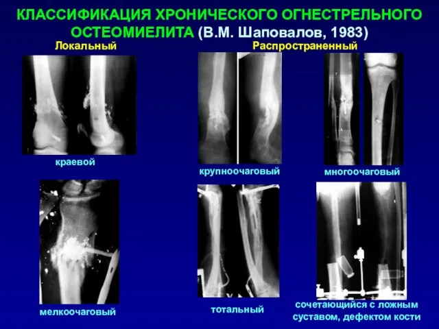 КЛАССИФИКАЦИЯ ХРОНИЧЕСКОГО ОГНЕСТРЕЛЬНОГО ОСТЕОМИЕЛИТА (В.М. Шаповалов, 1983)