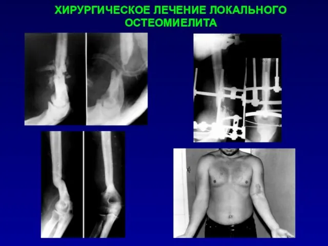 ХИРУРГИЧЕСКОЕ ЛЕЧЕНИЕ ЛОКАЛЬНОГО ОСТЕОМИЕЛИТА