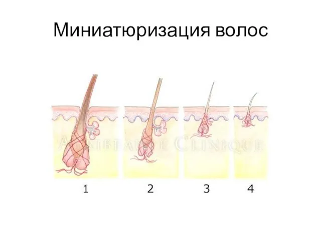 Миниатюризация волос