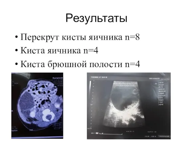 Результаты Перекрут кисты яичника n=8 Киста яичника n=4 Киста брюшной полости n=4