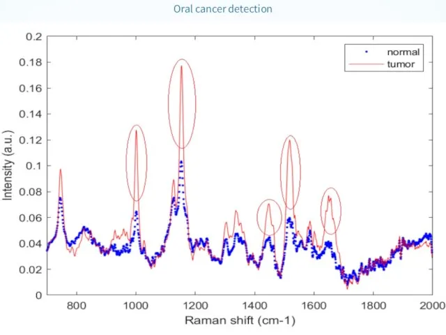 Oral cancer detection