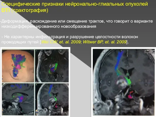 Специфические признаки нейронально-глиальных опухолей DTI (трактография) Деформация, расхождение или смещение трактов, что