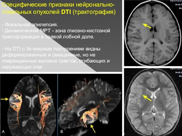 Специфические признаки нейронально-глиальных опухолей DTI (трактография) - Фокальная эпилепсия. - Динамические МРТ