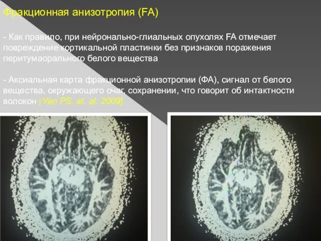 Фракционная анизотропия (FA) - Как правило, при нейронально-глиальных опухолях FA отмечает повреждение
