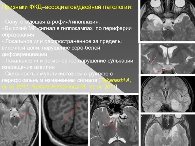 Признаки ФКД–ассоциатов/двойной патологии: - Сопутствующая атрофия/гипоплазия. - Высокий МР-сигнал в гиппокампах по