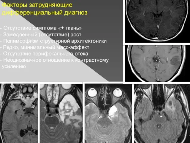 Факторы затрудняющие дифференциальный диагноз Отсутствие симптома «+ ткань» Замедленный (отсутствие) рост Полиморфизм