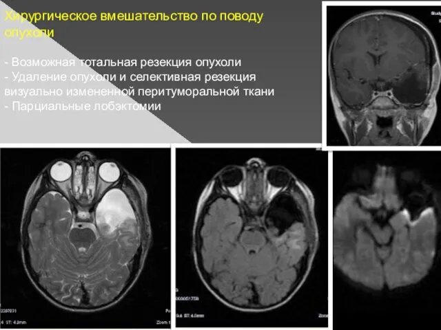 Хирургическое вмешательство по поводу опухоли - Возможная тотальная резекция опухоли - Удаление