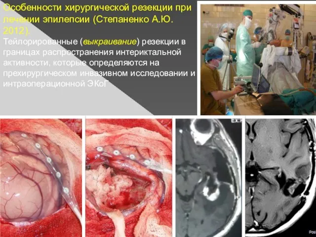 Особенности хирургической резекции при лечении эпилепсии (Степаненко А.Ю. 2012). Тейлорированные (выкраивание) резекции