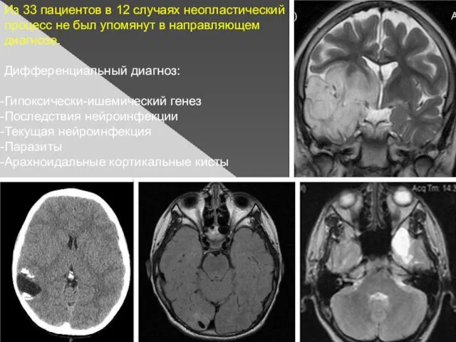 Из 33 пациентов в 12 случаях неопластический процесс не был упомянут в