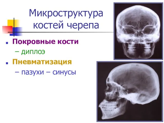 Микроструктура костей черепа Покровные кости – диплоэ Пневматизация – пазухи – синусы