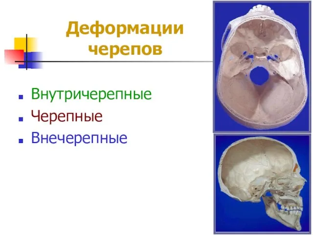 Деформации черепов Внутричерепные Черепные Внечерепные