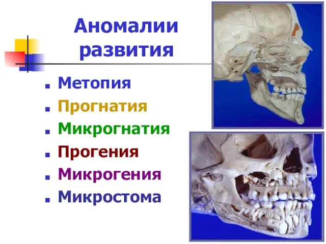 Аномалии развития Метопия Прогнатия Микрогнатия Прогения Микрогения Микростома