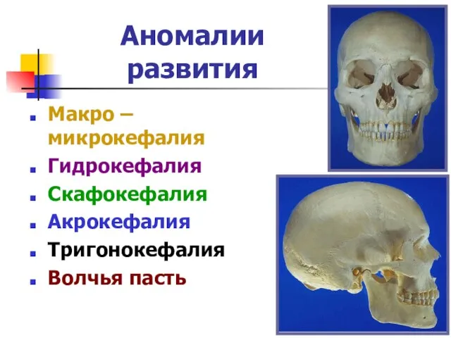 Аномалии развития Макро – микрокефалия Гидрокефалия Скафокефалия Акрокефалия Тригонокефалия Волчья пасть