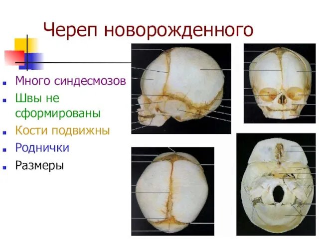 Череп новорожденного Много синдесмозов Швы не сформированы Кости подвижны Роднички Размеры