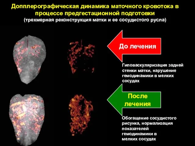 Допплерографическая динамика маточного кровотока в процессе предгестационной подготовки (трехмерная реконструкция матки и