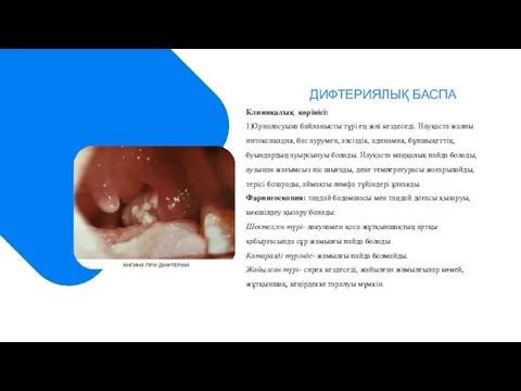 ДИФТЕРИЯЛЫҚ БАСПА Клиникалық көрінісі: 1)Орналасуына байланысты түрі ең жиі кездеседі. Науқаста жалпы