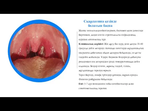 Скарлатина кезінде болатын баспа Жалпы интоксикация белгілерімен, баспамен және денесінде бөртпемен, жедел