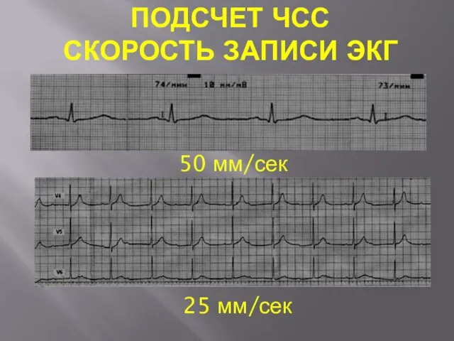 ПОДСЧЕТ ЧСС СКОРОСТЬ ЗАПИСИ ЭКГ 50 мм/сек 25 мм/сек