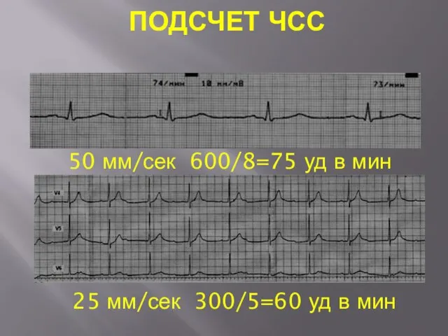 ПОДСЧЕТ ЧСС 50 мм/сек 600/8=75 уд в мин 25 мм/сек 300/5=60 уд в мин