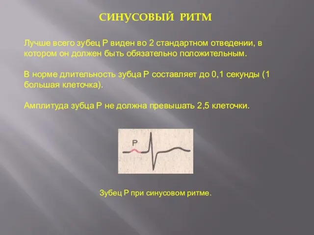 СИНУСОВЫЙ РИТМ Зубец P при синусовом ритме. Лучше всего зубец P виден