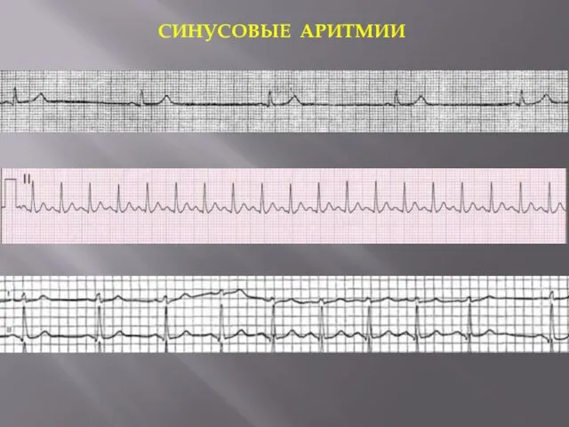 СИНУСОВЫЕ АРИТМИИ