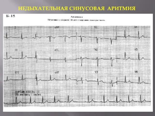 НЕДЫХАТЕЛЬНАЯ СИНУСОВАЯ АРИТМИЯ