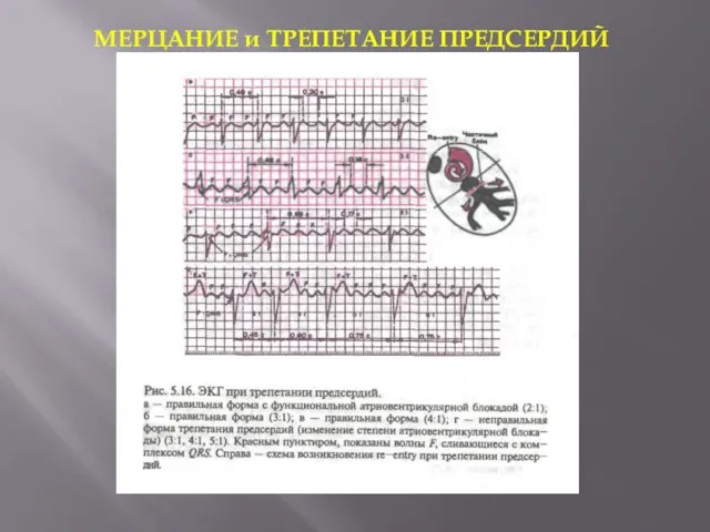 МЕРЦАНИЕ и ТРЕПЕТАНИЕ ПРЕДСЕРДИЙ