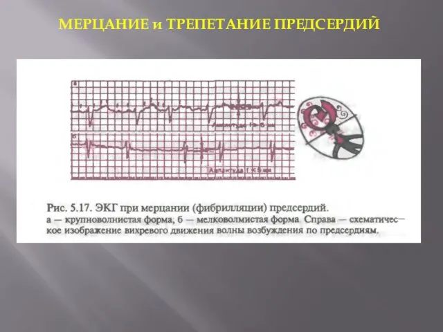 МЕРЦАНИЕ и ТРЕПЕТАНИЕ ПРЕДСЕРДИЙ