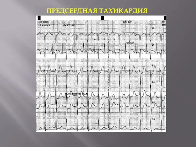 ПРЕДСЕРДНАЯ ТАХИКАРДИЯ