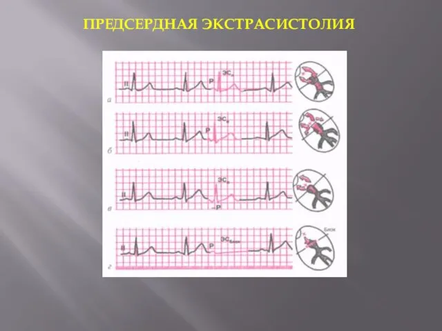 ПРЕДСЕРДНАЯ ЭКСТРАСИСТОЛИЯ