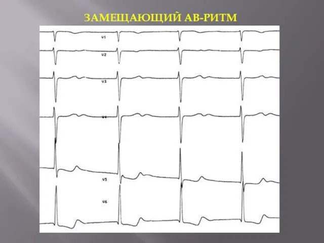 ЗАМЕЩАЮЩИЙ АВ-РИТМ