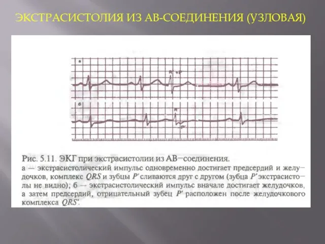 ЭКСТРАСИСТОЛИЯ ИЗ АВ-СОЕДИНЕНИЯ (УЗЛОВАЯ)