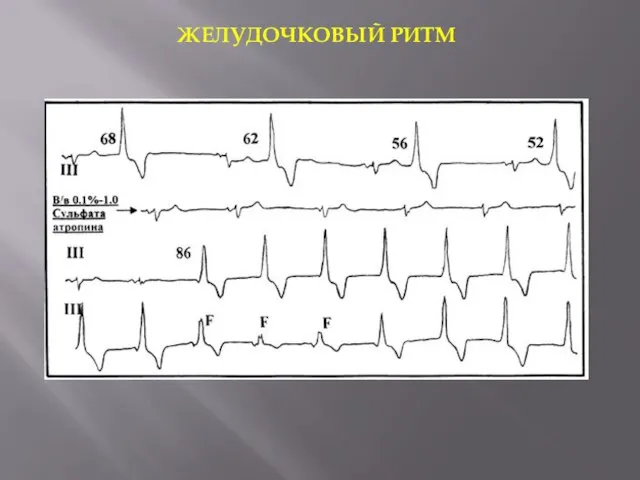 ЖЕЛУДОЧКОВЫЙ РИТМ