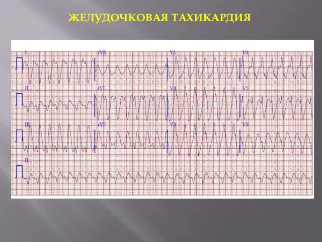 ЖЕЛУДОЧКОВАЯ ТАХИКАРДИЯ