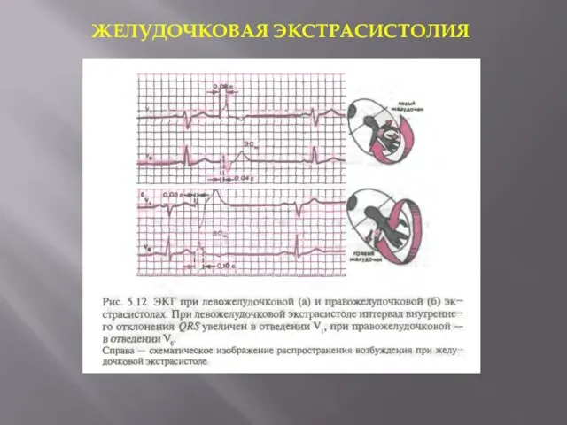 ЖЕЛУДОЧКОВАЯ ЭКСТРАСИСТОЛИЯ