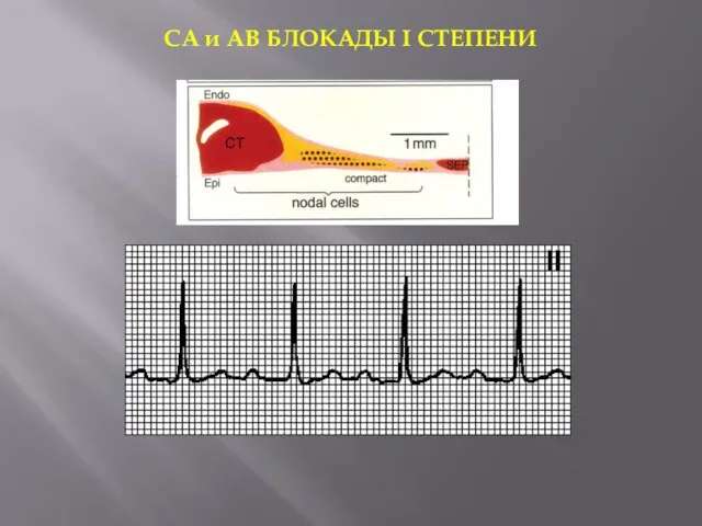 СА и АВ БЛОКАДЫ I СТЕПЕНИ