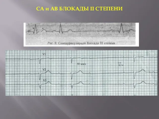 СА и АВ БЛОКАДЫ II СТЕПЕНИ