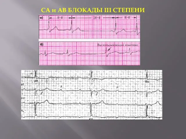 СА и АВ БЛОКАДЫ III СТЕПЕНИ