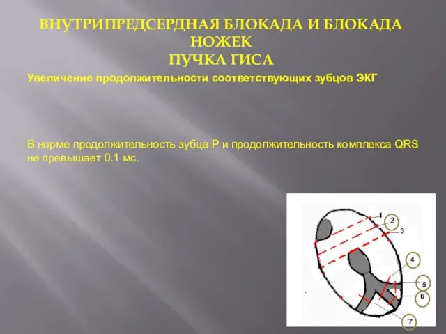 ВНУТРИПРЕДСЕРДНАЯ БЛОКАДА И БЛОКАДА НОЖЕК ПУЧКА ГИСА Увеличение продолжительности соответствующих зубцов ЭКГ