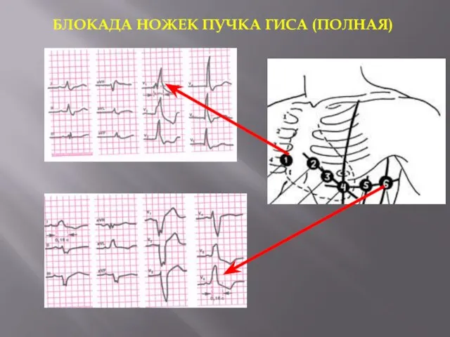 БЛОКАДА НОЖЕК ПУЧКА ГИСА (ПОЛНАЯ)