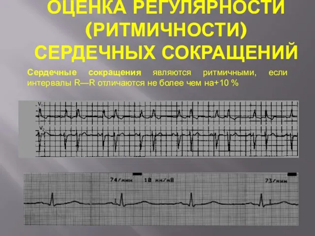 ОЦЕНКА РЕГУЛЯРНОСТИ (РИТМИЧНОСТИ) СЕРДЕЧНЫХ СОКРАЩЕНИЙ Сердечные сокращения являются ритмичными, если интервалы R—R