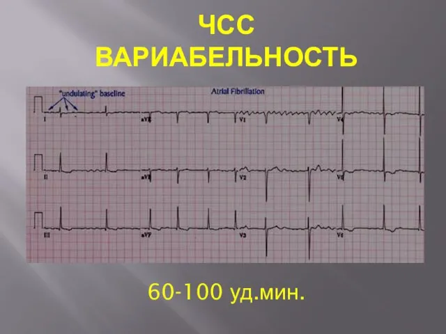 ЧСС ВАРИАБЕЛЬНОСТЬ 150-60 уд.мин. 60-100 уд.мин.