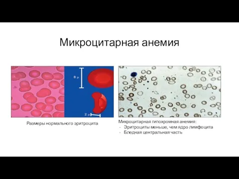 Микроцитарная анемия Микроцитарная гипохромная анемия: Эритроциты меньше, чем ядро лимфоцита Бледная центральная часть Размеры нормального эритроцита